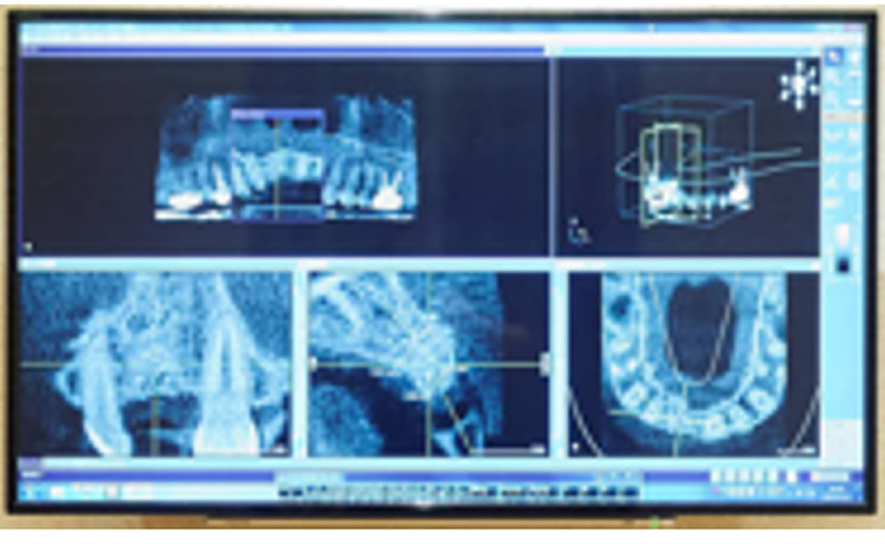 歯科用CT