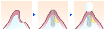 インプラント手術におけるGBR（骨誘導再生）法のイメージ図｜恵比寿の歯医者 恵比寿デンタルクリニック東京のインプラント