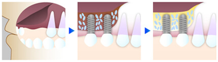 インプラント手術におけるサイナスリフトのイメージ図｜恵比寿の歯医者 恵比寿デンタルクリニック東京のインプラント