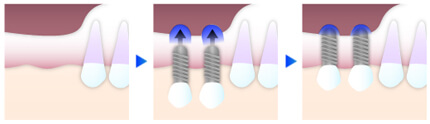 インプラント手術におけるソケットリフトのイメージ図｜恵比寿の歯医者 恵比寿デンタルクリニック東京のインプラント