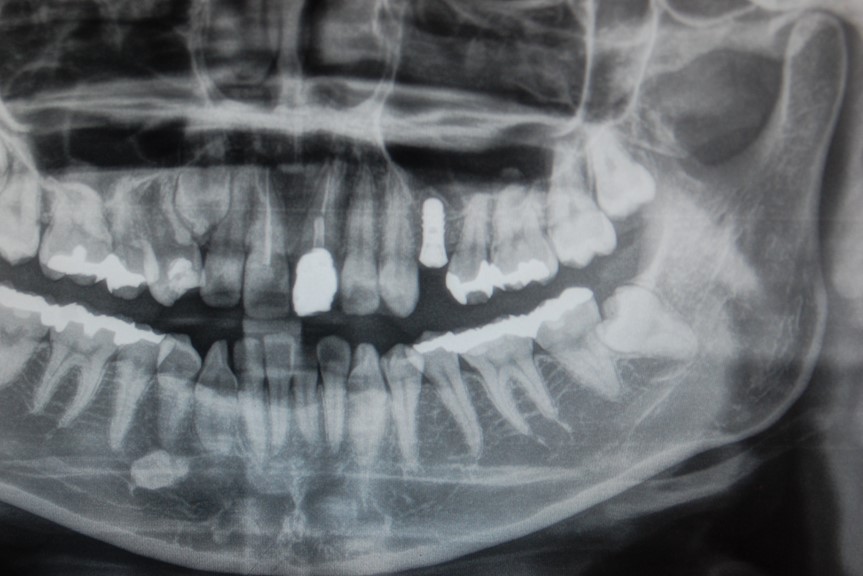 恵比寿デンタルクリニック東京｜ソケットリフトによるインプラント埋入｜来院時のレントゲン画像２