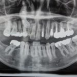 【症例】歯の寿命を延ばす、インプラントアンカーによる部分矯正（MTM）
