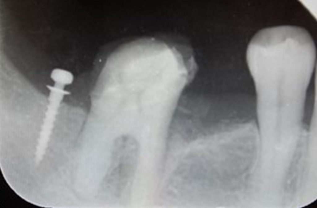 歯の寿命を延ばす、インプラントアンカーによる部分矯正（MTM）の症例 治療後、歯が起きた状態のレントゲン画像｜恵比寿の歯医者｜恵比寿デンタルクリニック東京