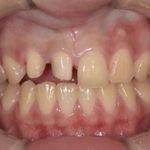 【症例】ジルコニアセラミッククラウンによる前歯の審美回復