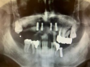 インプラントによる入れ歯の固定 症例 インプラント埋入後のレントゲン画像 ｜恵比寿の歯医者｜恵比寿デンタルクリニック東京