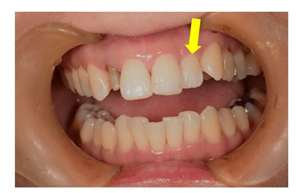 【症例】劣化したレジンをジルコニアセラミッククラウンへ。天然歯のような美しさの再現と歯の寿命への配慮｜治療する歯の反対側の同名歯の色を指す口腔内画像｜恵比寿の歯医者｜恵比寿デンタルクリニック東京