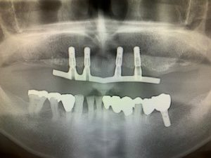 インプラントによる入れ歯の固定 症例 バーアタッチメント装着時のレントゲン画像 ｜恵比寿の歯医者｜恵比寿デンタルクリニック東京