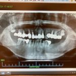 インプラントによる入れ歯の固定 症例 治療前のレントゲン画像 ｜恵比寿の歯医者｜恵比寿デンタルクリニック東京