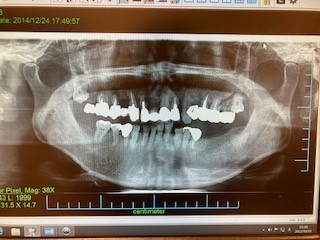 インプラントによる入れ歯の固定 症例 治療前のレントゲン画像 ｜恵比寿の歯医者｜恵比寿デンタルクリニック東京