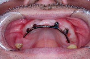 インプラントによる入れ歯の固定 症例 アタッチメントバー装着時の口腔内写真 ｜恵比寿の歯医者｜恵比寿デンタルクリニック東京