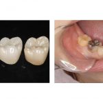【症例】ジルコニアを用いた奥歯に対する審美歯科治療
