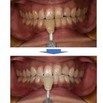 【症例】レジンの詰め物がある方のオフィスホワイトニング
