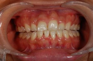 【症例】ティオンのホワイトニングで美しく白い歯に（30代女性）｜恵比寿の歯医者 恵比寿デンタルクリニック東京の症例｜ホワイトニング前の画像