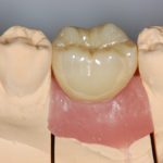 【症例】インプラント上部構造にペクトンアバットメントを用いた残存歯にやさしいインプラント治療