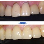 【症例】古くなった前歯の被せ物の下で進行した虫歯の処置とジルコニアクラウンによるやり替え