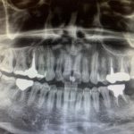 【症例】歯科医師が身内に行ったインプラント治療（やはりインプラント治療はおすすめです！）