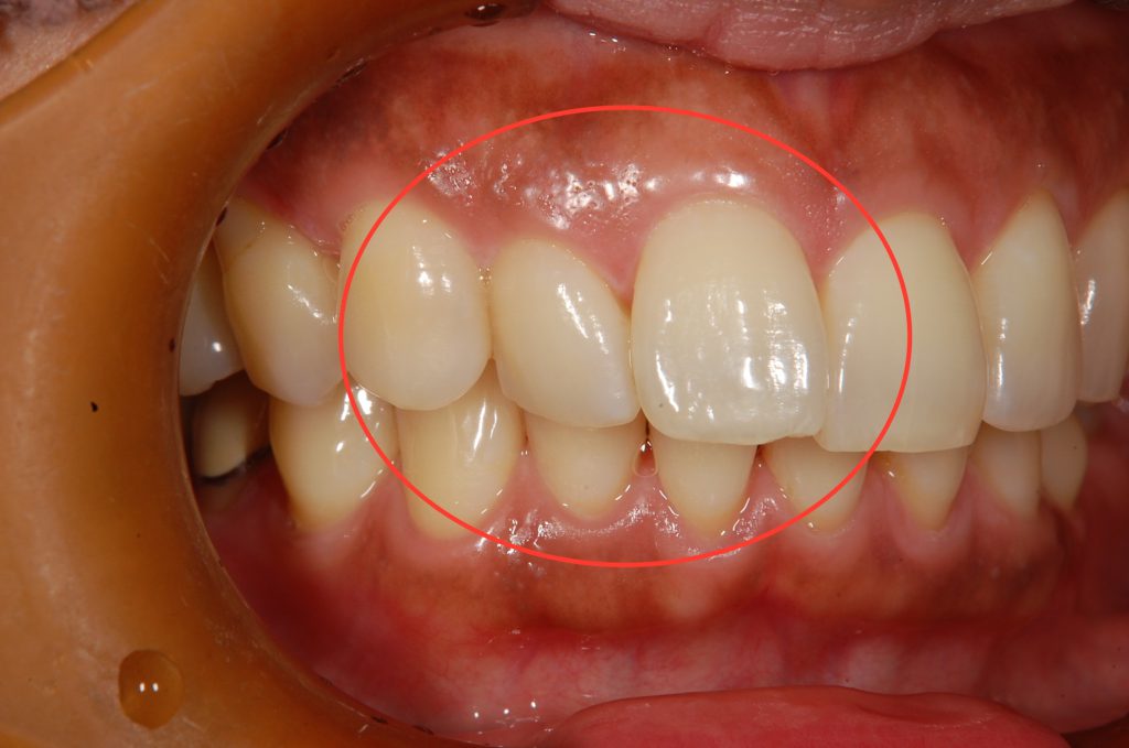 【症例】前歯の簡単な審美矯正～費用を押さえたマウスピースでの矯正治療～｜恵比寿の歯医者 恵比寿デンタルクリニック東京の症例｜改善したい部分の歯