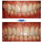 【症例】前歯の簡単な審美矯正～費用を押さえたマウスピースでの矯正治療～｜恵比寿の歯医者 恵比寿デンタルクリニック東京の症例｜beforeafter