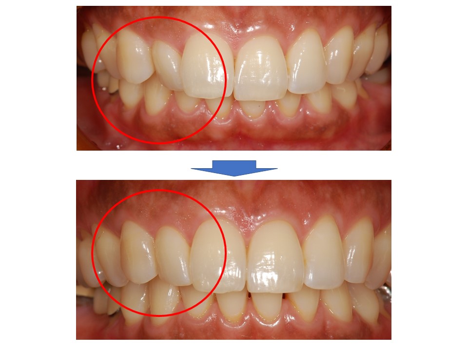 【症例】前歯の簡単な審美矯正～費用を押さえたマウスピースでの矯正治療～｜恵比寿の歯医者 恵比寿デンタルクリニック東京の症例｜beforeafter