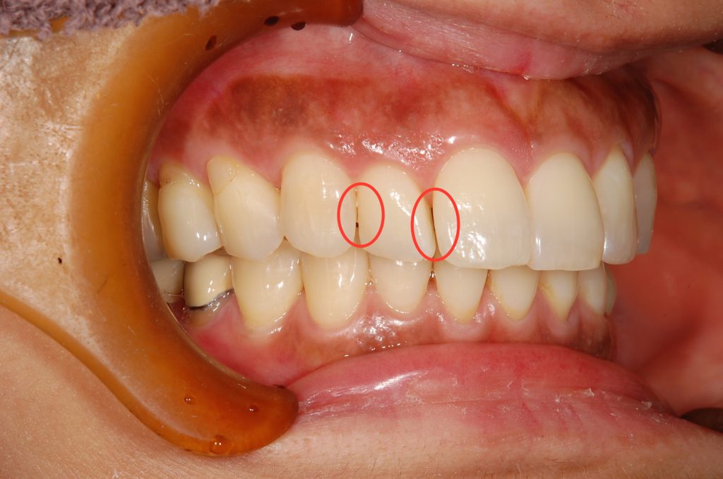 【症例】前歯の簡単な審美矯正～費用を押さえたマウスピースでの矯正治療～｜恵比寿の歯医者 恵比寿デンタルクリニック東京の症例｜歯を削った箇所