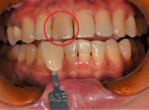 【症例】神経の治療（根管治療）後変色した歯の治療と古くなったレジンの詰め物のやりかえ｜治療前の画像｜恵比寿の歯医者 恵比寿デンタルクリニック東京