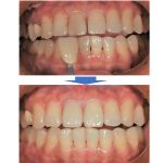 【症例】神経の治療（根管治療）後変色した歯の治療と古くなったレジンの詰め物のやりかえ｜治療前治療後の比較画像｜恵比寿の歯医者 恵比寿デンタルクリニック東京