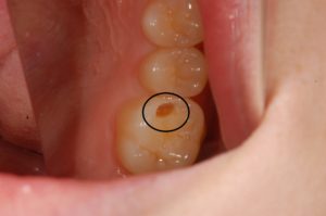 【症例】コンポジットレジンを使用した保険診療での金属を使わない虫歯治療｜治療中の虫歯