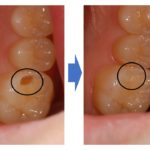 【症例】コンポジットレジンを使用した保険診療での金属を使わない虫歯治療｜治療前治療後比較画像