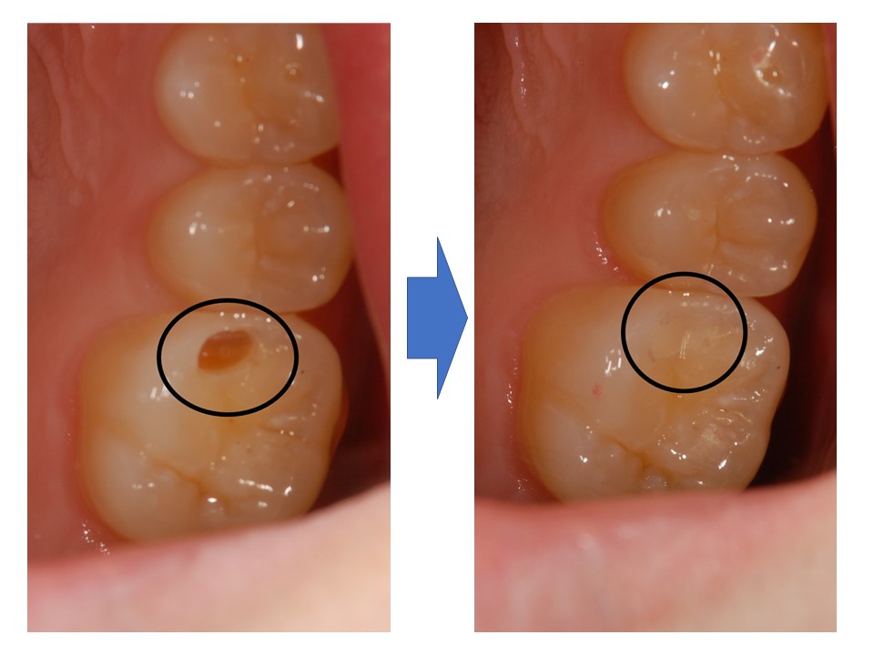 症例】コンポジットレジンを使用した保険診療での金属を使わない虫歯 