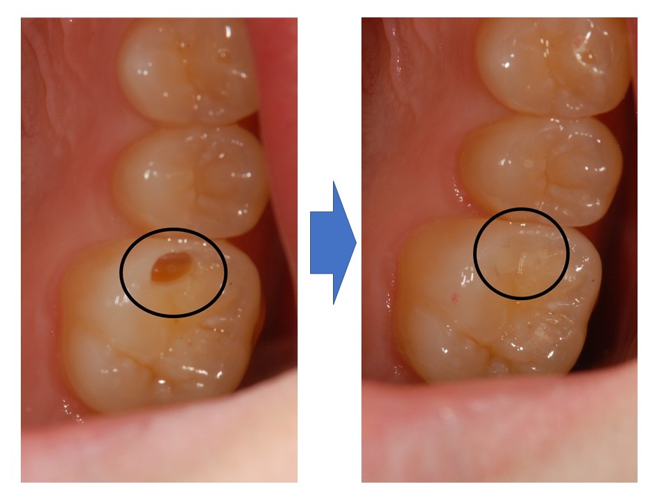【症例】コンポジットレジンを使用した保険診療での金属を使わない虫歯治療｜治療前治療後比較画像