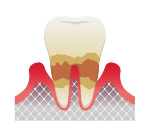 歯石取りと歯周病治療｜縁下歯石｜恵比寿の歯医者 恵比寿デンタルクリニック東京