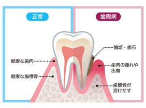 歯周病が全身疾患に繋がってしまう仕組みを解説｜歯周病の画像｜恵比寿の歯医者 恵比寿デンタルクリニック東京