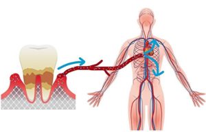 歯周病が全身疾患に繋がってしまう仕組みを解説｜歯周病と全身疾患の画像｜恵比寿の歯医者 恵比寿デンタルクリニック東京