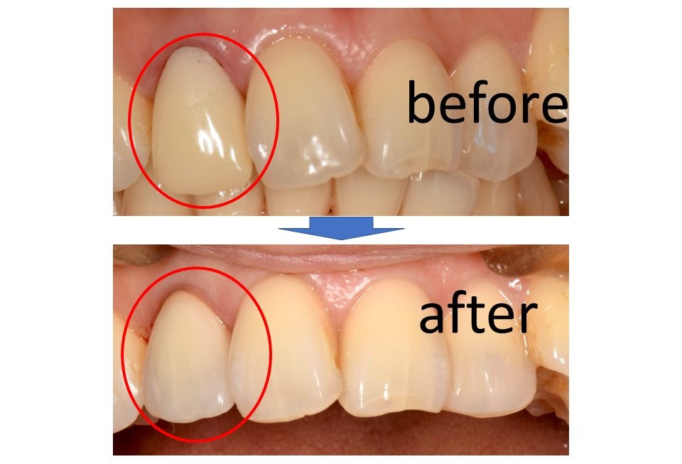 【症例】前歯の被せ物をより自然な見た目に｜治療前治療後｜恵比寿の歯医者｜恵比寿デンタルクリニック東京
