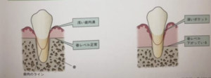 恵比寿デンタルクリニック東京｜歯肉退縮の原因とは？予防するためのブラッシングのポイントも解説｜骨と歯茎の画像