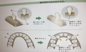 恵比寿デンタルクリニック東京｜歯肉退縮の原因とは？予防するためのブラッシングのポイントも解説｜土台の骨の画像