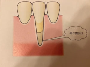 恵比寿デンタルクリニック東京｜歯肉退縮の原因とは？予防するためのブラッシングのポイントも解説｜骨が露出した画像