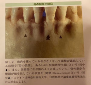 恵比寿デンタルクリニック東京｜歯肉退縮の原因とは？予防するためのブラッシングのポイントも解説｜歯根が露出した画像