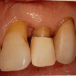 恵比寿デンタルクリニック東京｜歯周病による歯肉退縮の原因とは？予防するためのブラッシングのポイントも解説｜歯肉退縮の画像