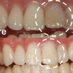 【症例】神経治療後の歯の変色と歯の形をジルコニアセラミックにより改善