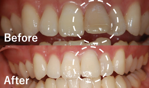 恵比寿デンタルクリニック東京｜【症例】神経治療後の歯の変色と歯の形をジルコニアセラミックにより改善｜ビフォーアフター