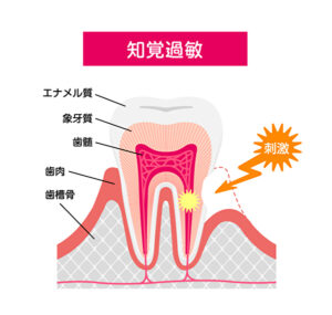 恵比寿デンタルクリニック東京｜ブログ｜知覚過敏の原因と予防方法について｜知覚過敏とは？
