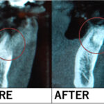 【症例】土台となる骨が不足していてもGBR（骨造成）治療でインプラント埋入を可能に