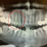 【症例】歯根破折した歯を抜歯後、インプラントで治療