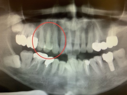 恵比寿デンタルクリニック東京｜症例｜【症例】歯根破折した歯を抜歯後、インプラントで治療｜アイキャッチ画像