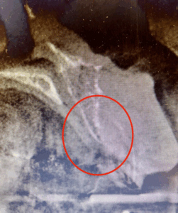 抜歯後画像｜【症例】歯茎（歯肉）の移植と骨造成で被せ物をより自然な仕上がりに｜恵比寿の歯医者　恵比寿デンタルクリニック東京