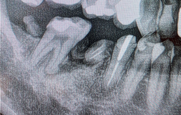 治療前レントゲン画像｜【症例】咬みやすい歯列をつくるための包括的歯科治療｜恵比寿デンタルクリニック東京