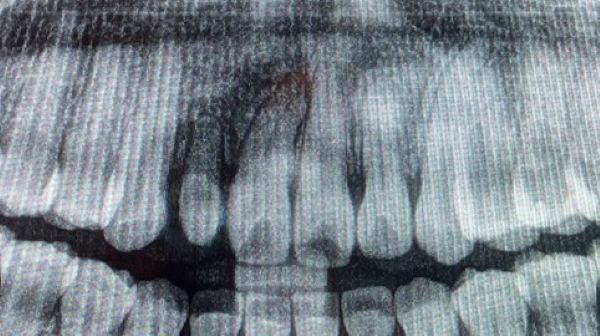 【症例】ぐらぐらしている大人の乳歯をインプラント治療で自然な前歯に