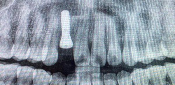 治療詳細レントゲン画像｜【症例】ぐらぐらしている大人の乳歯をインプラント治療で自然な前歯に｜恵比寿デンタルクリニック東京