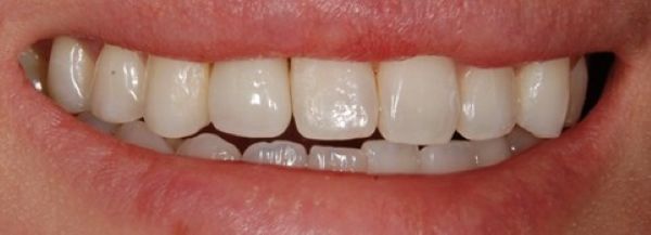 治療後画像｜【症例】ぐらぐらしている大人の乳歯をインプラント治療で自然な前歯に｜恵比寿デンタルクリニック東京